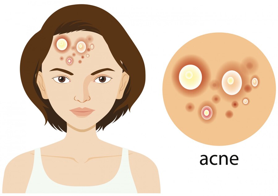 Acne Scar Solutions in Noida