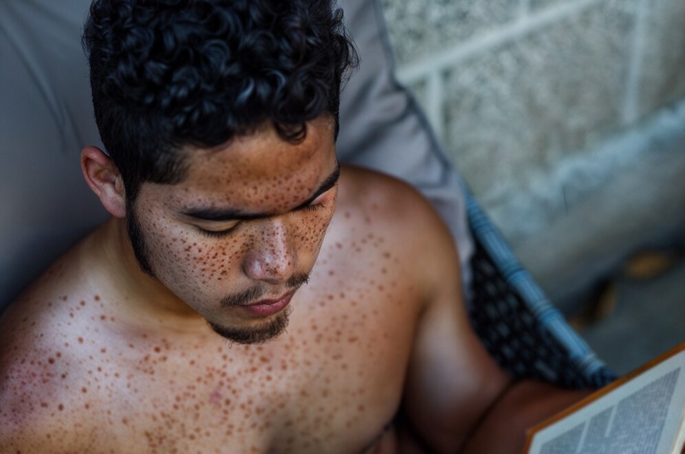 Seborrheic Dermatitis Treatment at Dermanation Clinic in Noida